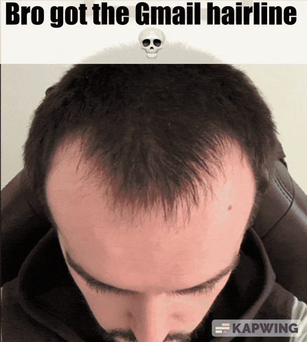 Hairline Meme GIF